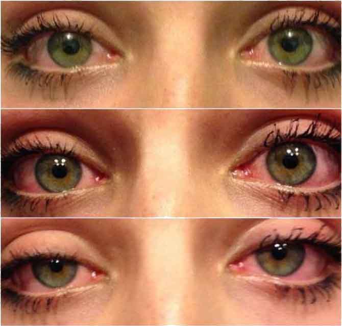 Tak wyglądają oczy po paleniu marihuany - ciężkie powieki i przekrwione oczy