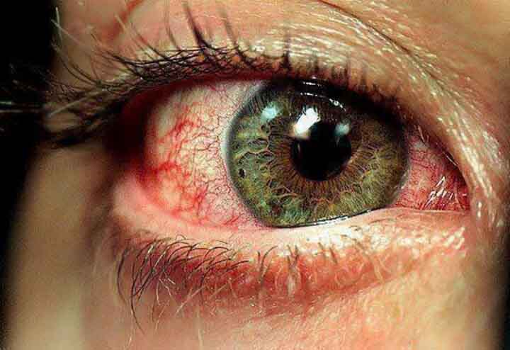 Przekrwione oko po paleniu marihuany