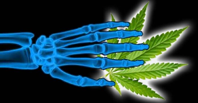 Badania pokazały, że użytkownicy marihuany mieli niższą gęstość kości niż osoby, które jej nie używają