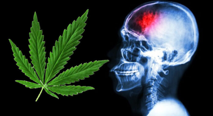 używanie marihuany a ryzyko udaru mózgu