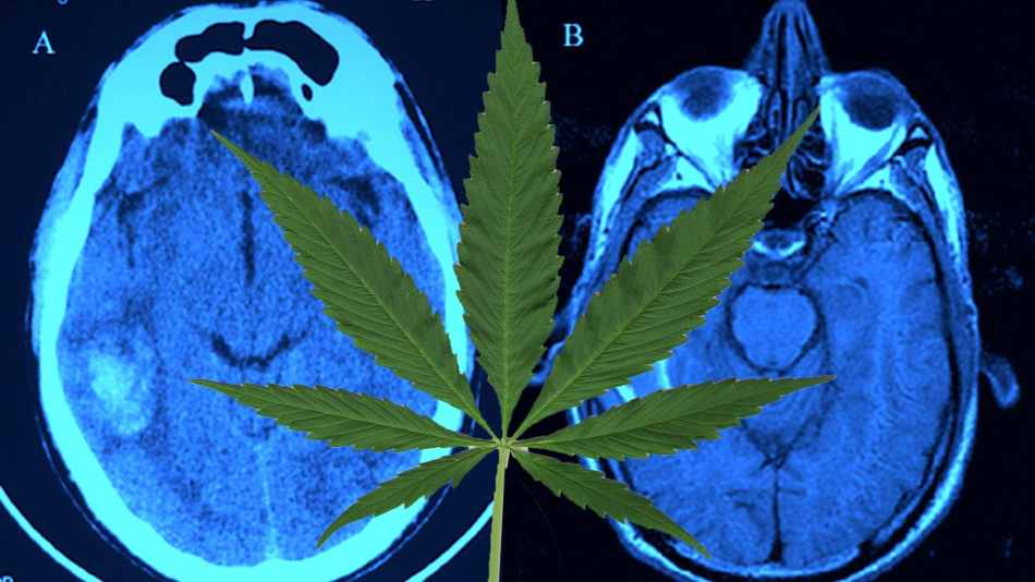 okazjonalne używanie marihuany może powodować zmiany w niektórych obszarach mózgu