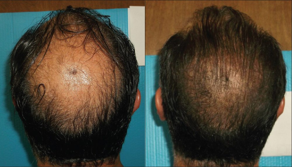 Porównanie gęstości włosów w badaniu nad skutecznością CBD